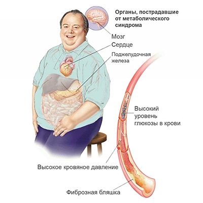 Метаболический Синдром